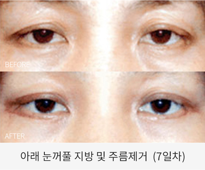 아래 눈꺼풀 지방 및 주름제거