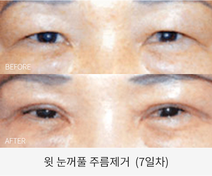 윗 눈꺼풀 주름제거