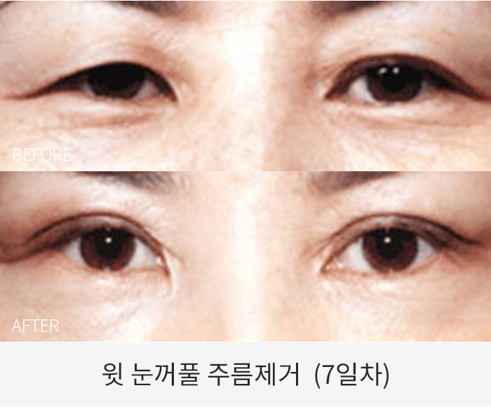 윗 눈꺼풀 주름제거