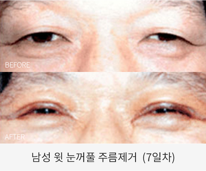 윗 눈꺼풀 주름제거
