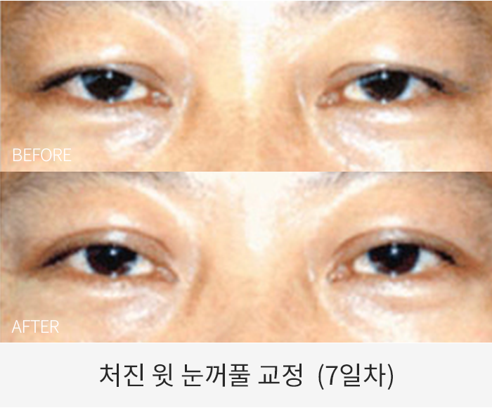 처진 윗 눈꺼풀 교정