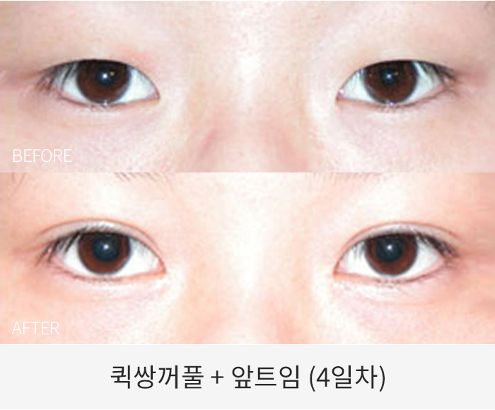 퀵쌍꺼풀+앞트임