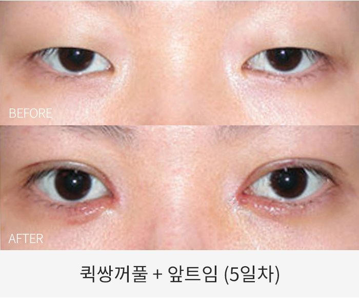 퀵쌍꺼풀+앞트임