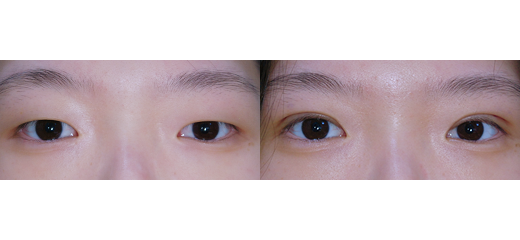 퀵쌍꺼풀(수술 직후)