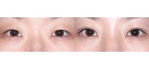 퀵쌍꺼풀(수술 4일차)