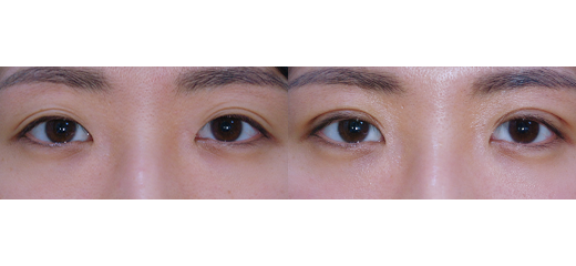 퀵쌍꺼풀(수술 직후)