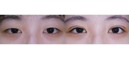 퀵쌍꺼풀(수술 직후)